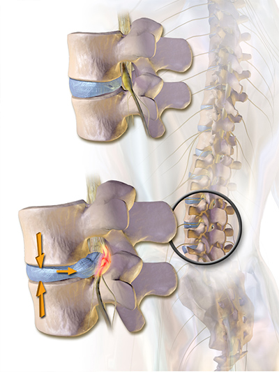 Lumbar Microdiscectomy