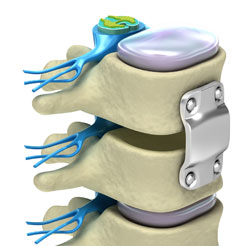 Cervical Fusion